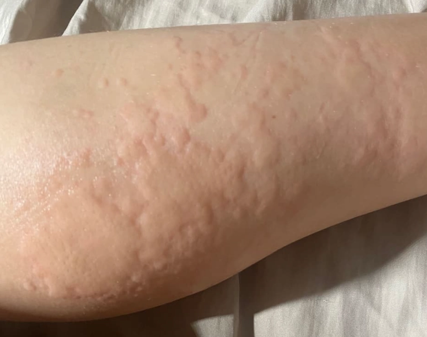 蕁麻疹止癢方法