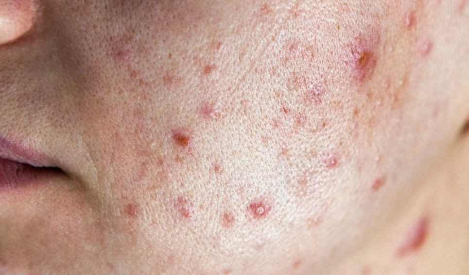 臉頰長痘原因