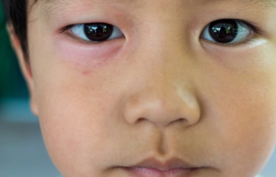 眼睛腫起來急救