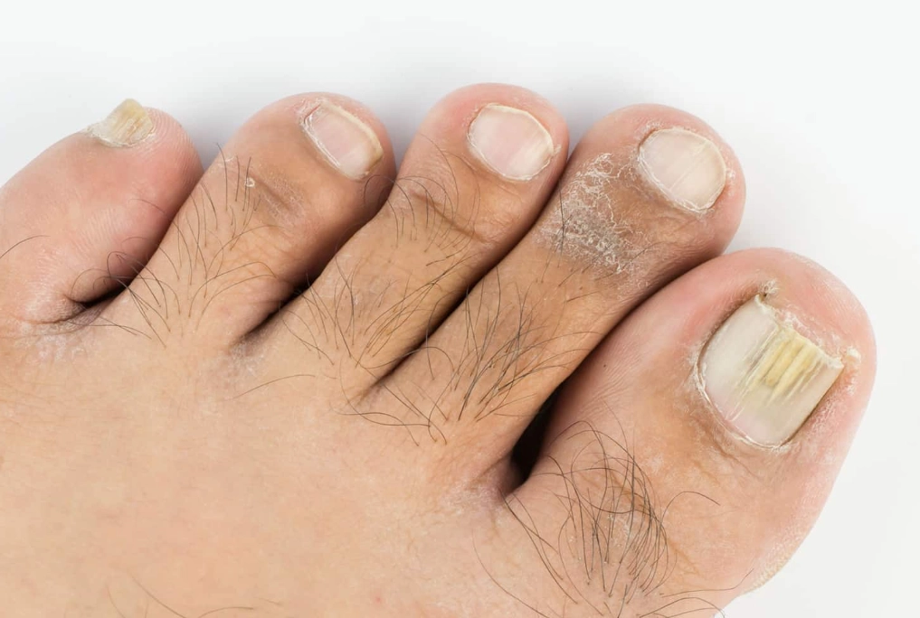 指甲變厚原因
