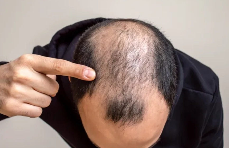 預防禿頭