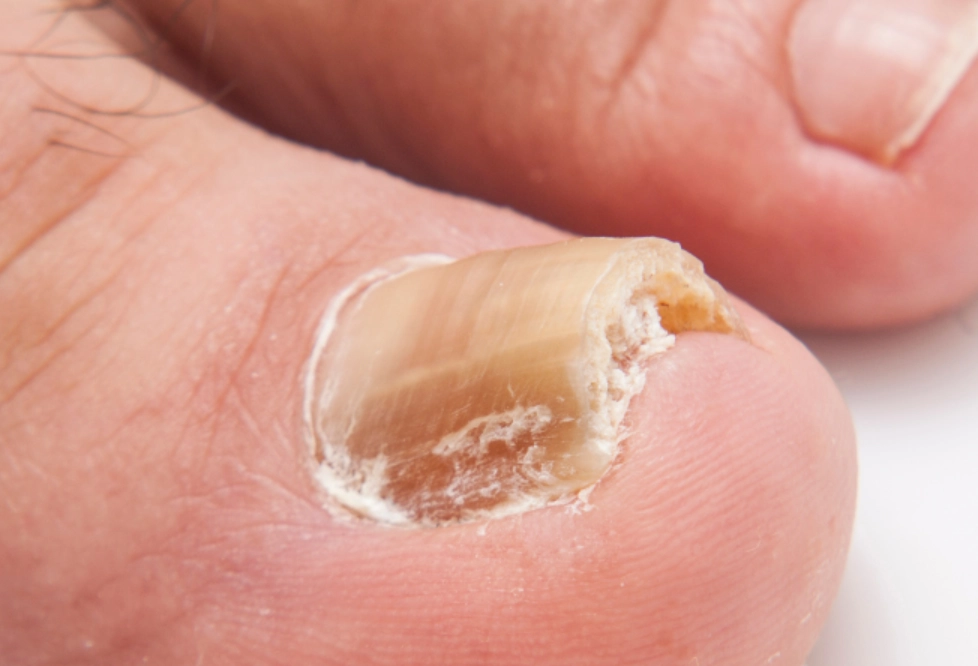 腳指甲變厚處理