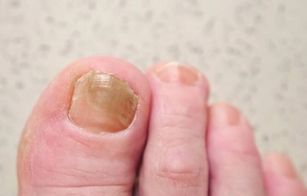 腳指甲變厚處理