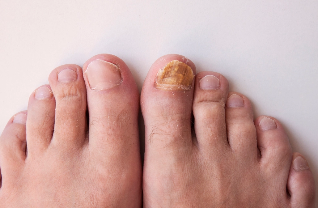 腳指甲變厚處理