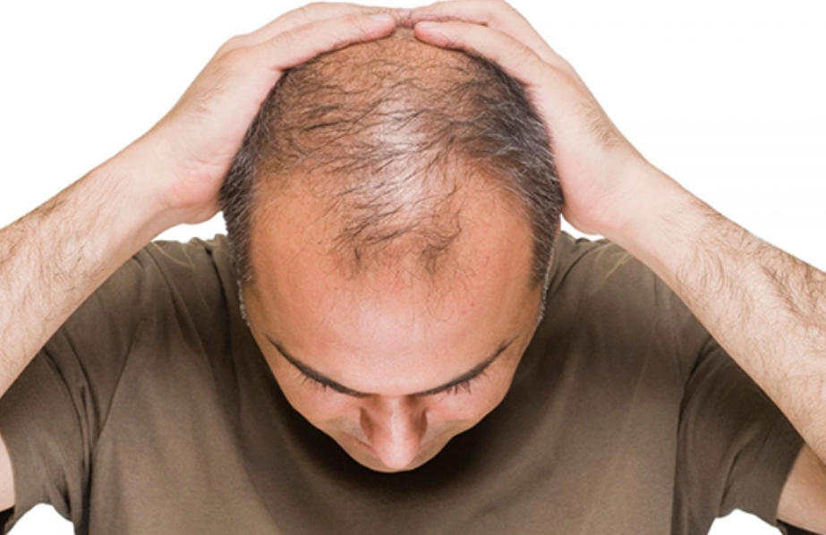 預防禿頭