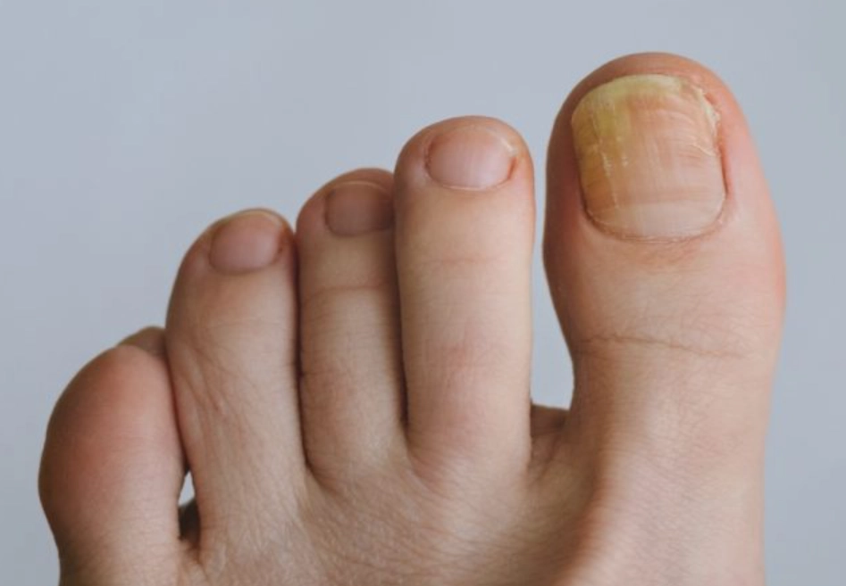 指甲變厚原因