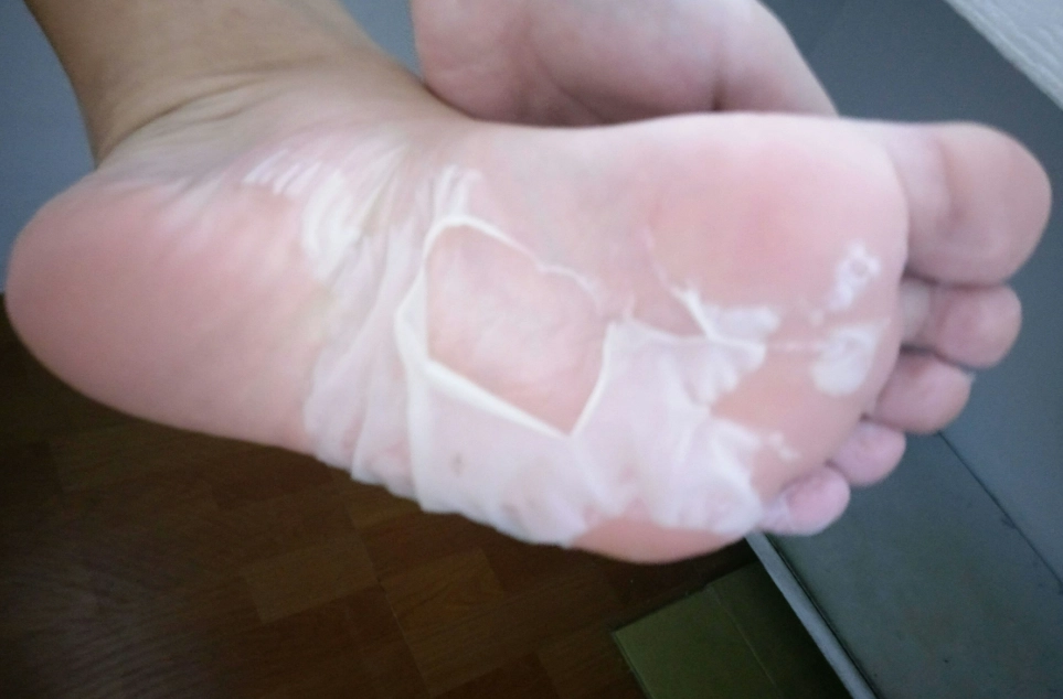腳脫皮治療