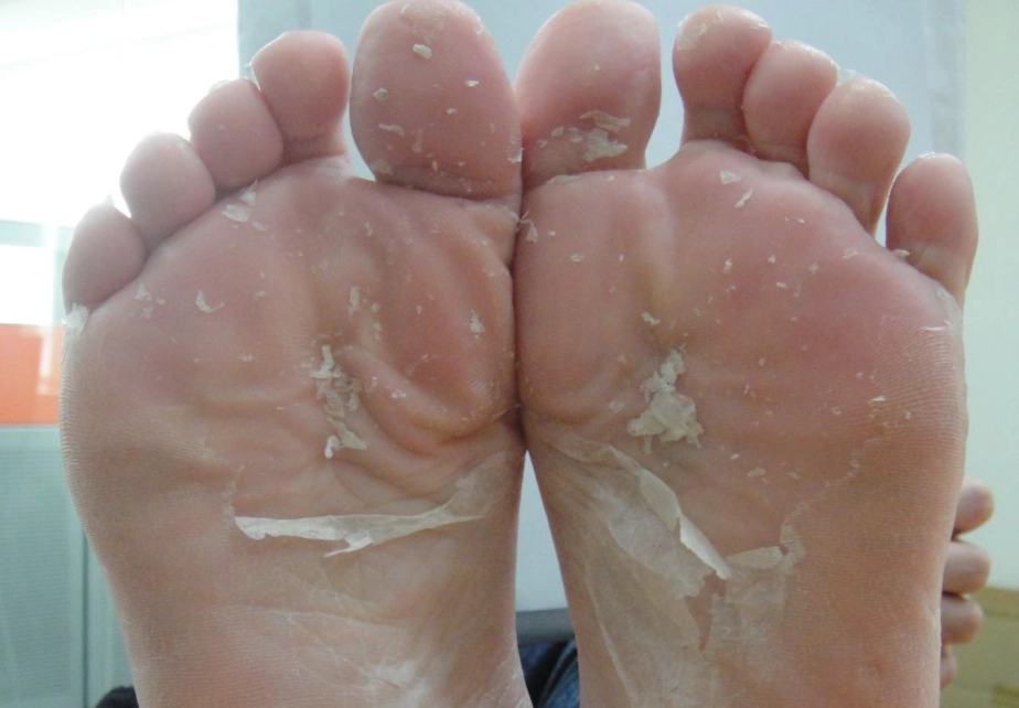 腳脫皮治療