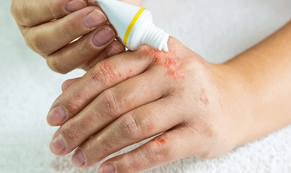 富貴手怎麼治療