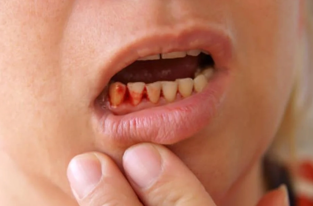 牙周病症狀 牙周病症狀