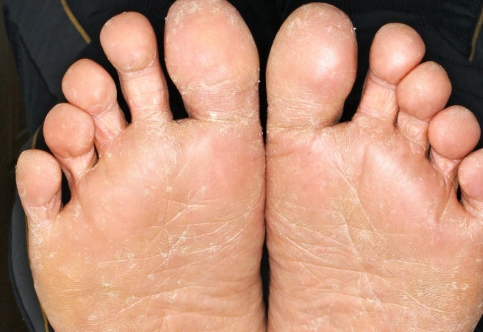 香港腳脫皮原因