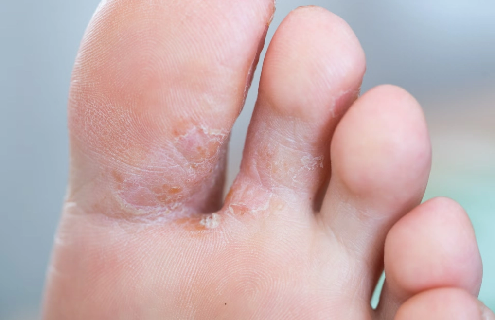 香港腳脫皮治療