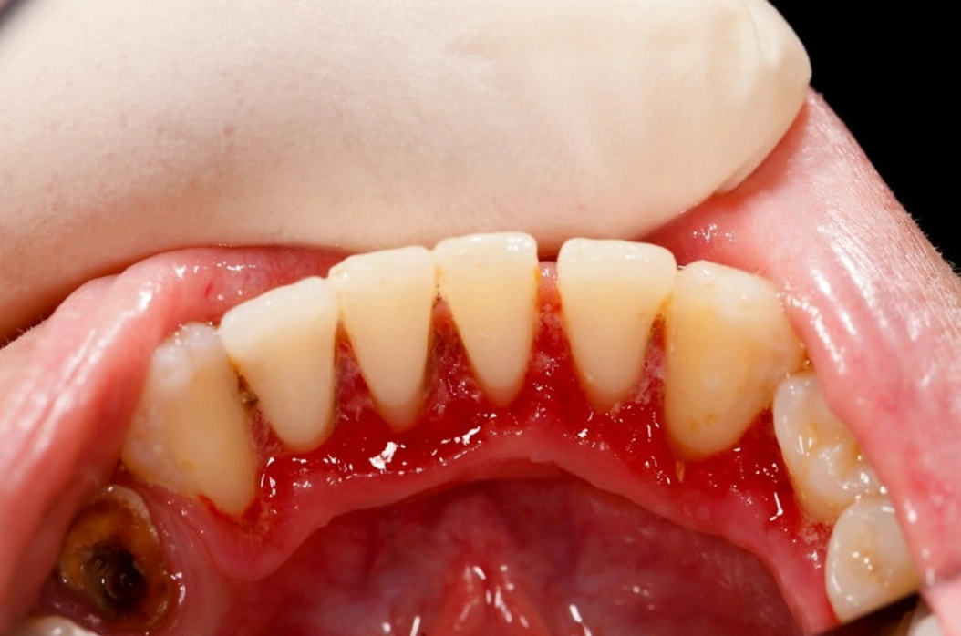 牙齦流血治療 牙齦流血治療