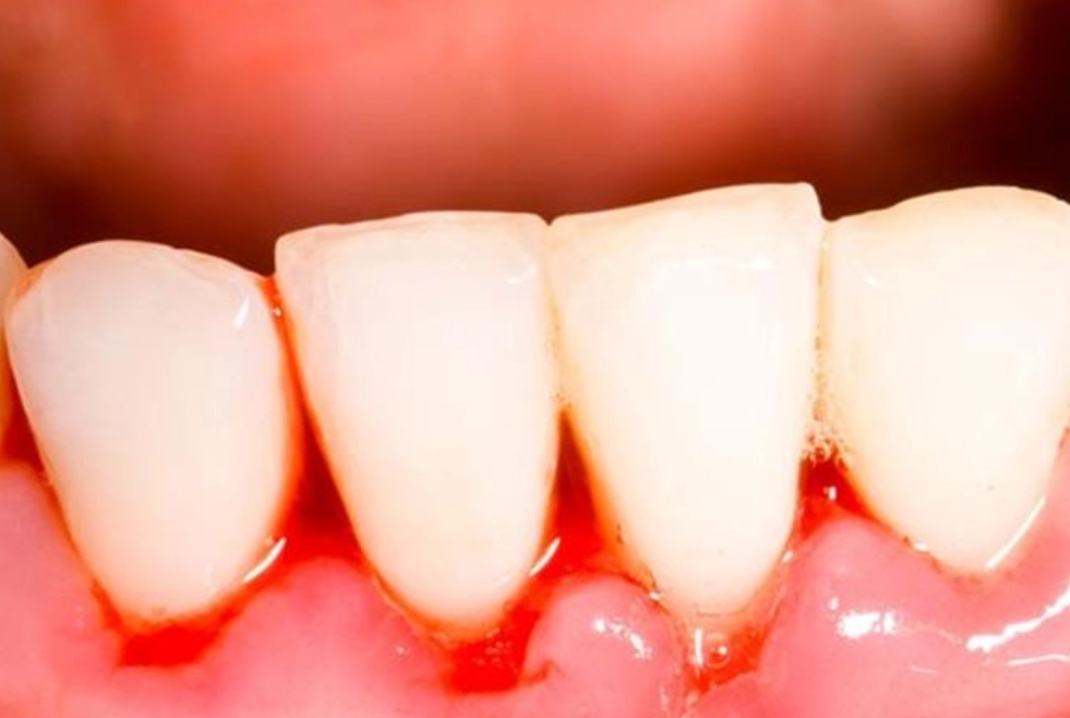 牙齦流血治療 牙齦流血治療