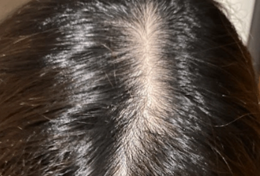 女性禿頭治療方法