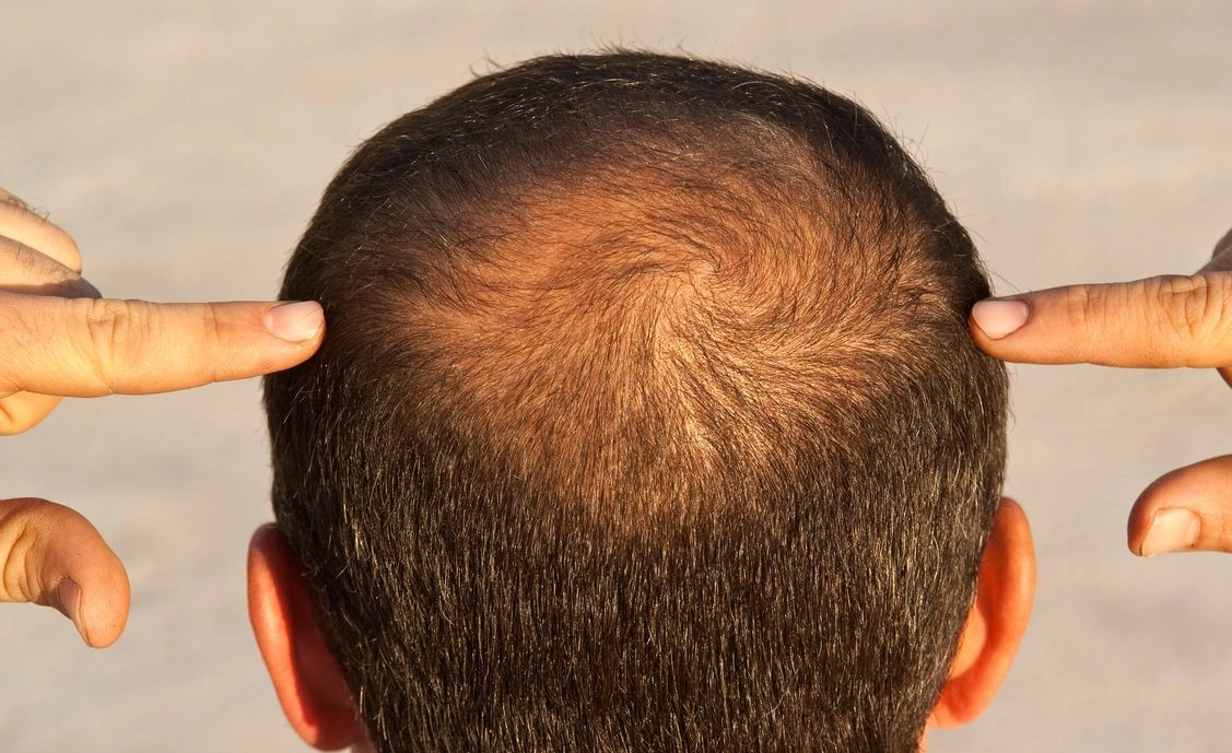 雄性禿藥物 雄性禿藥物