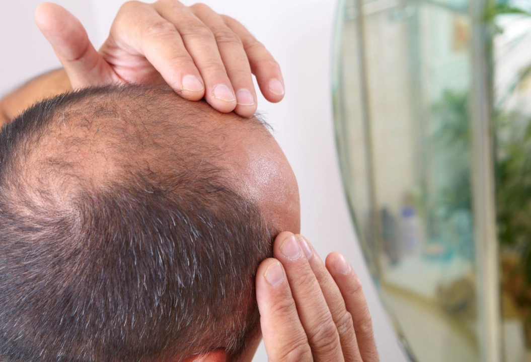 雄性禿植髮 雄性禿植髮