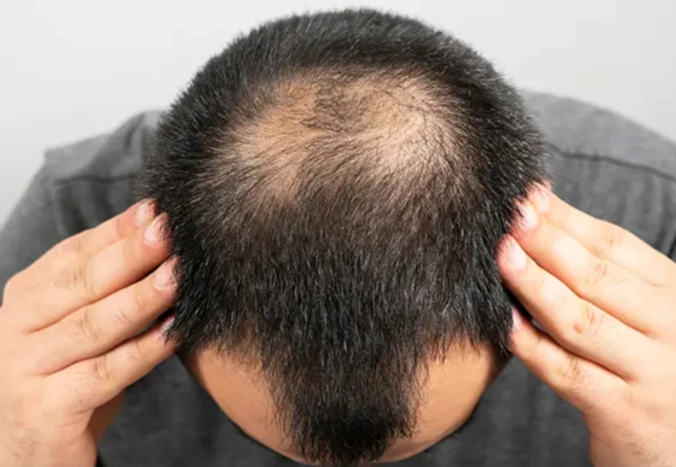 雄性禿植髮 雄性禿植髮