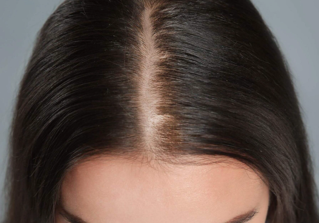 女性禿頭治療方法