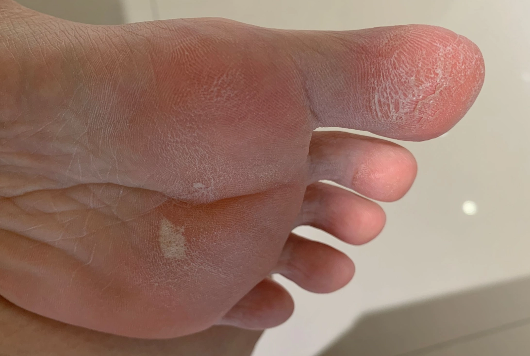 腳底脫皮