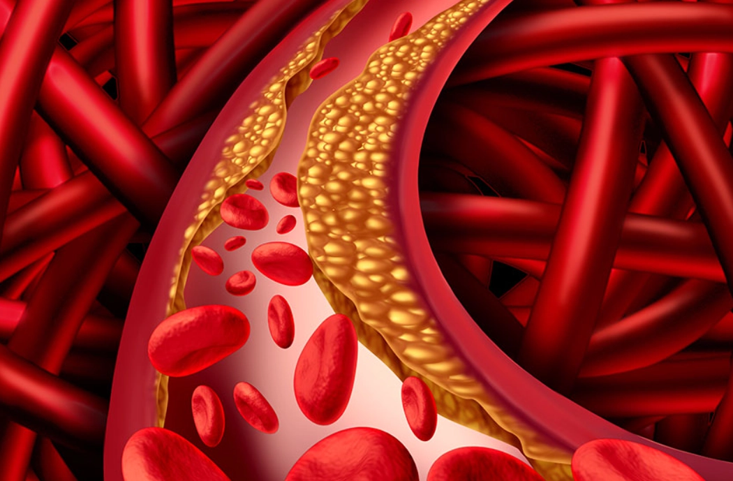 高膽固醇 高膽固醇