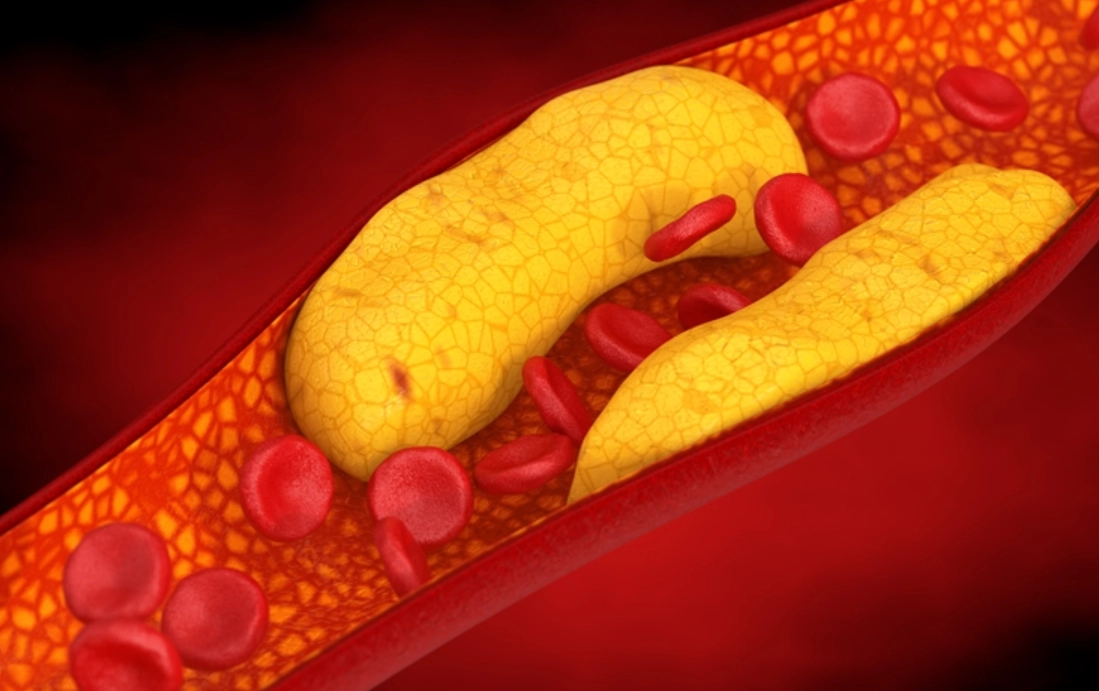 高膽固醇症症狀