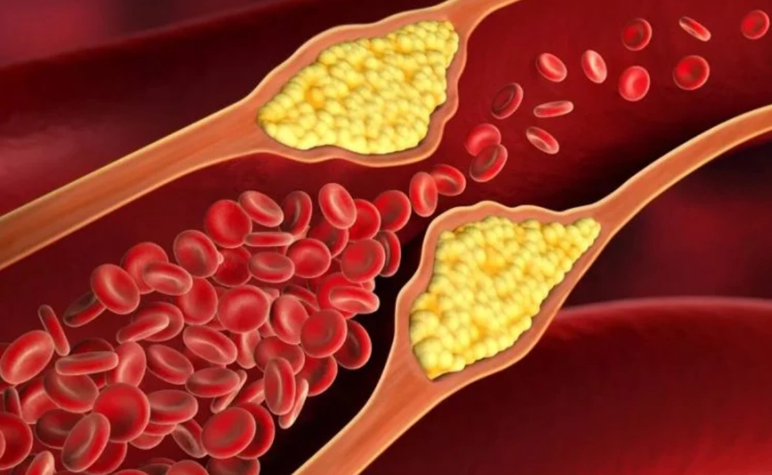 高膽固醇危害 高膽固醇危害