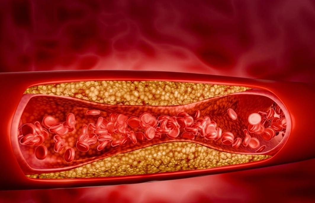 降低膽固醇飲食