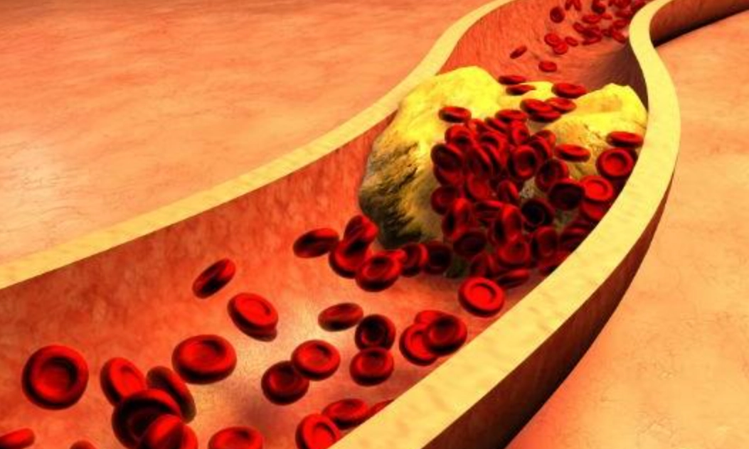 膽固醇檢查標準