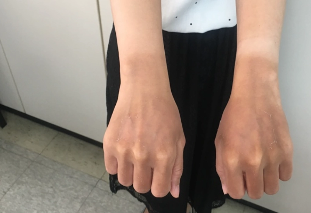 曬傷怎麼白回來