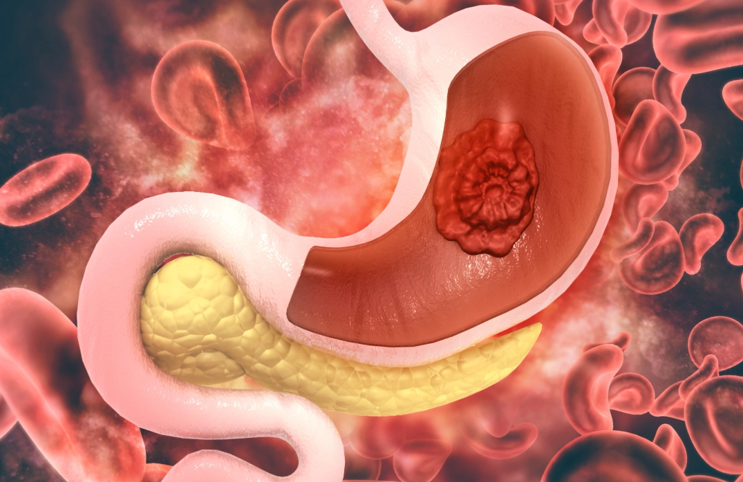 胃抽筋緩解方法