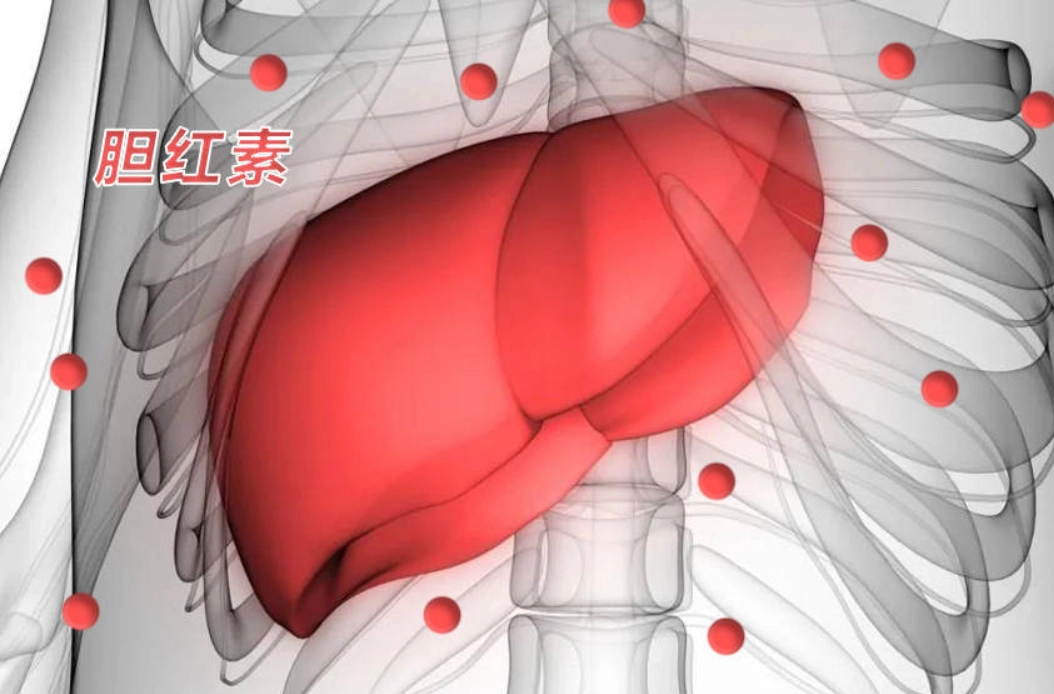 膽紅素偏高原因