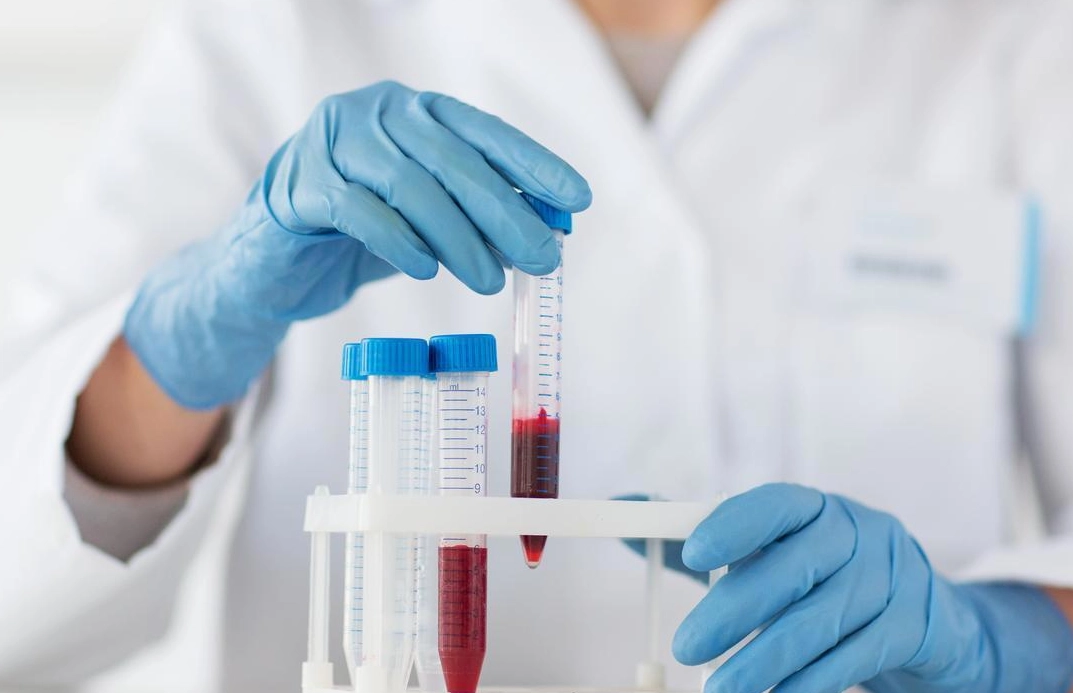 膽紅素偏高原因