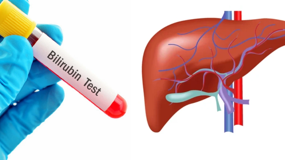 膽紅素偏高原因