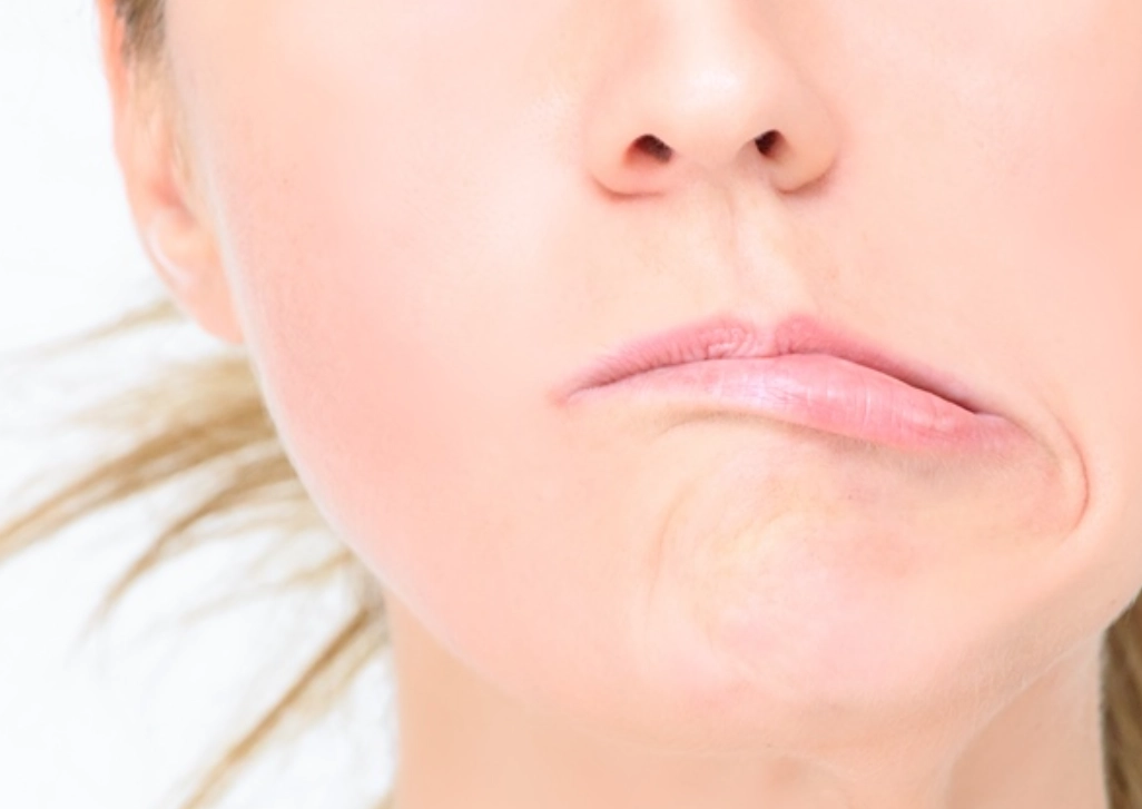 顏面神經麻痺原因