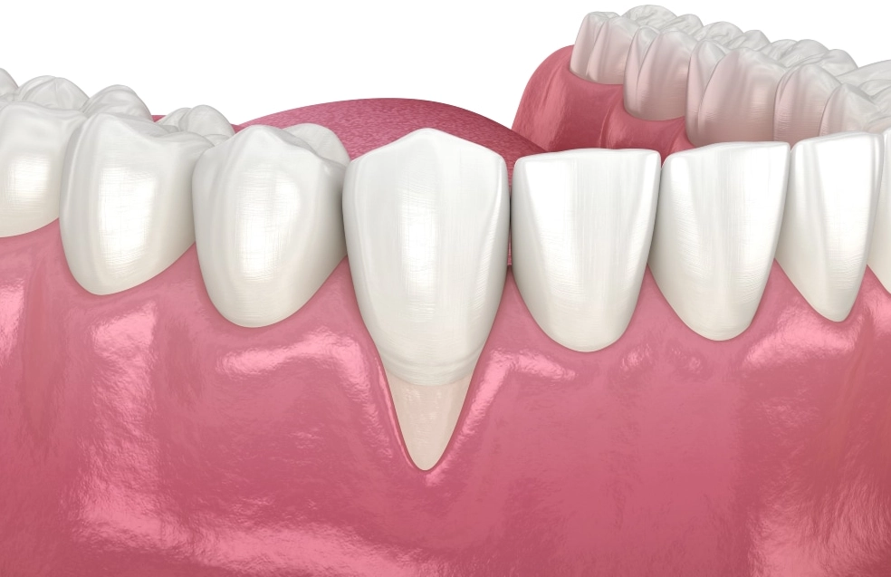 牙齦萎縮怎麼辦