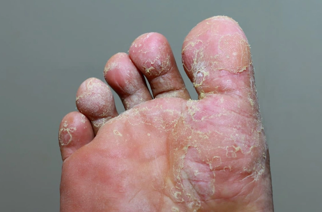 香港腳脫皮怎麼辦