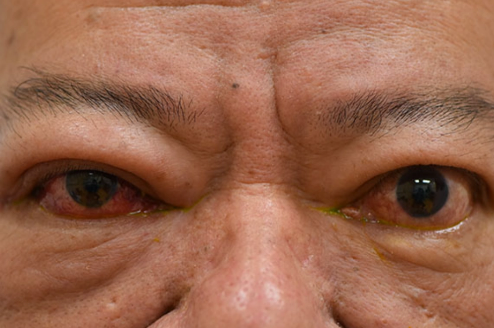 眼睛腫起來怎麼辦