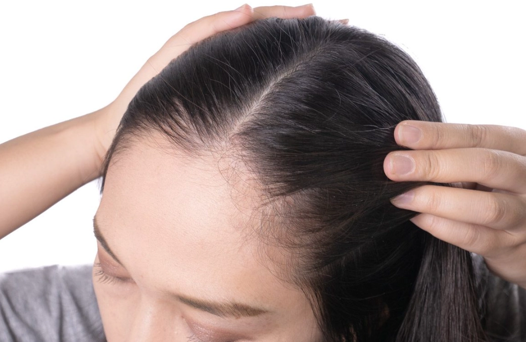 女性禿頭怎麼辦