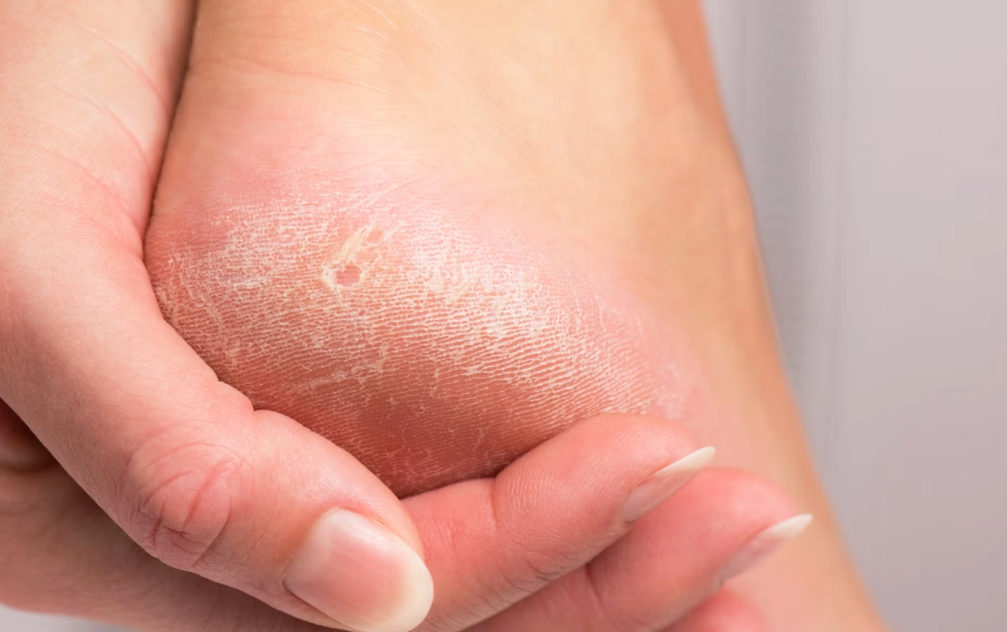 腳脫皮治療方法