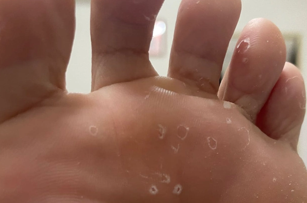 腳脫皮不癢原因 腳脫皮不癢原因