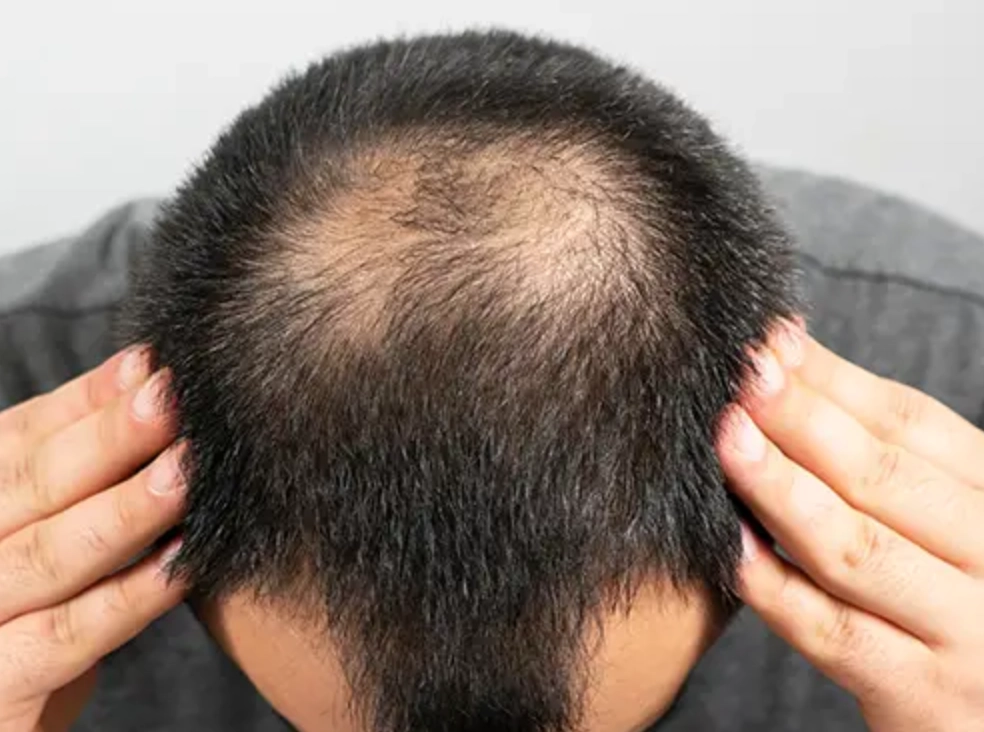 男性禿頭原因