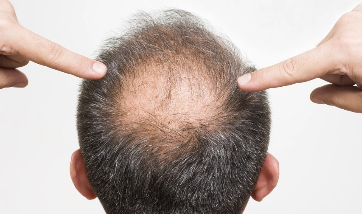 男性禿頭原因