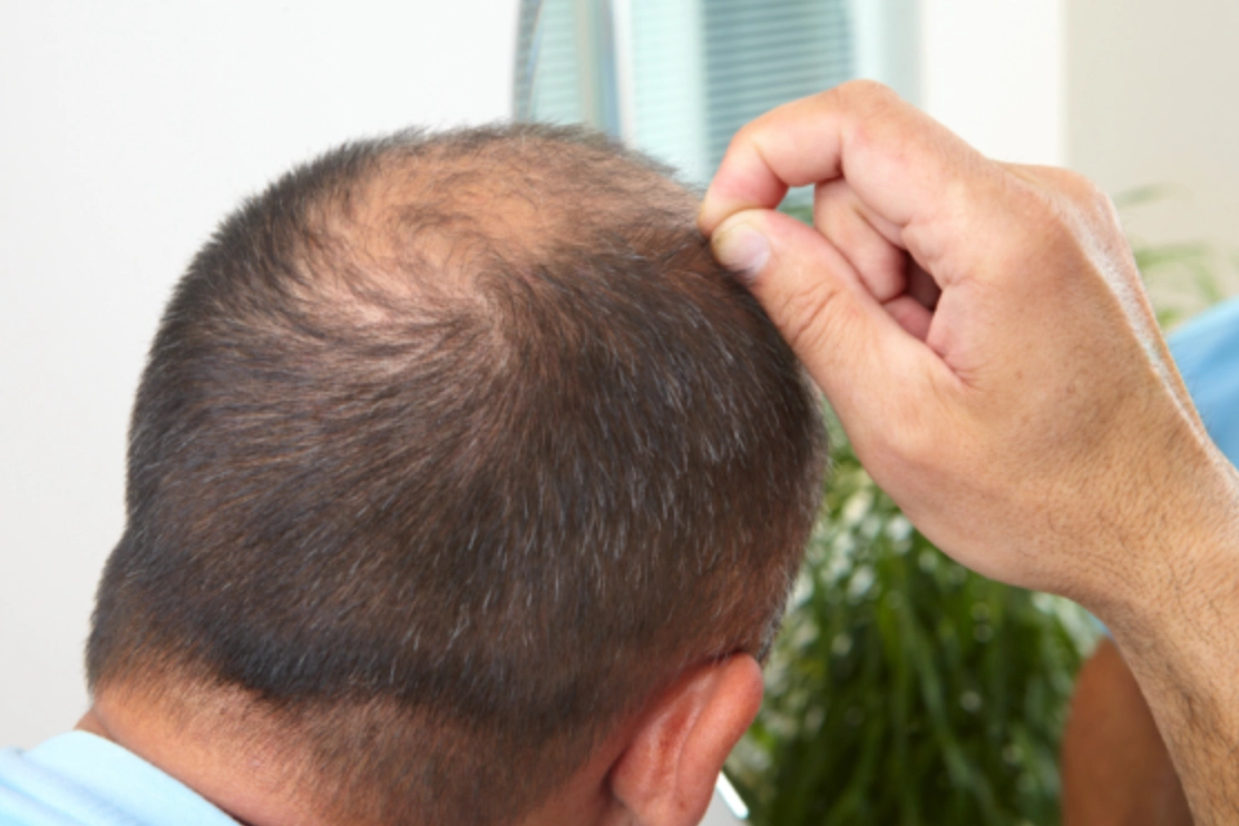 男性禿頭原因