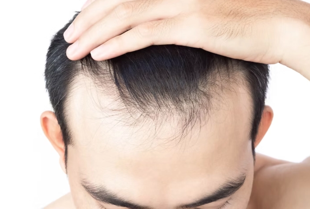 雄性禿治療