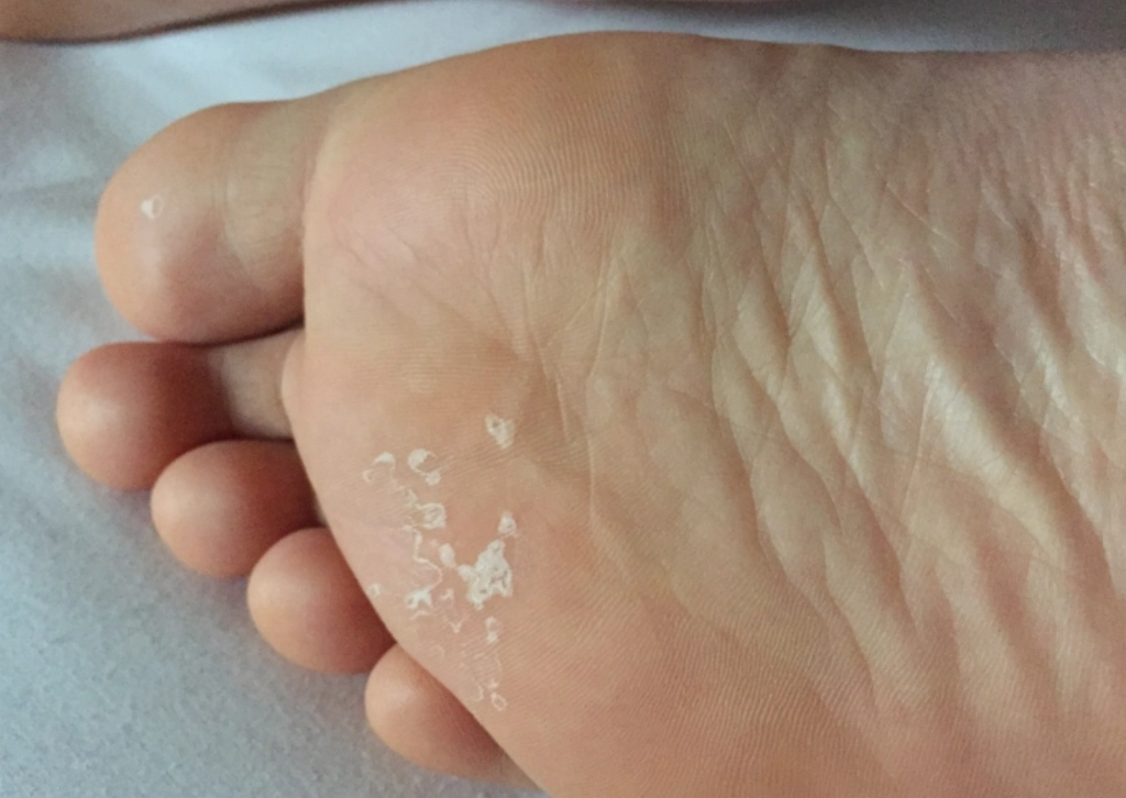 腳底脫皮維生素