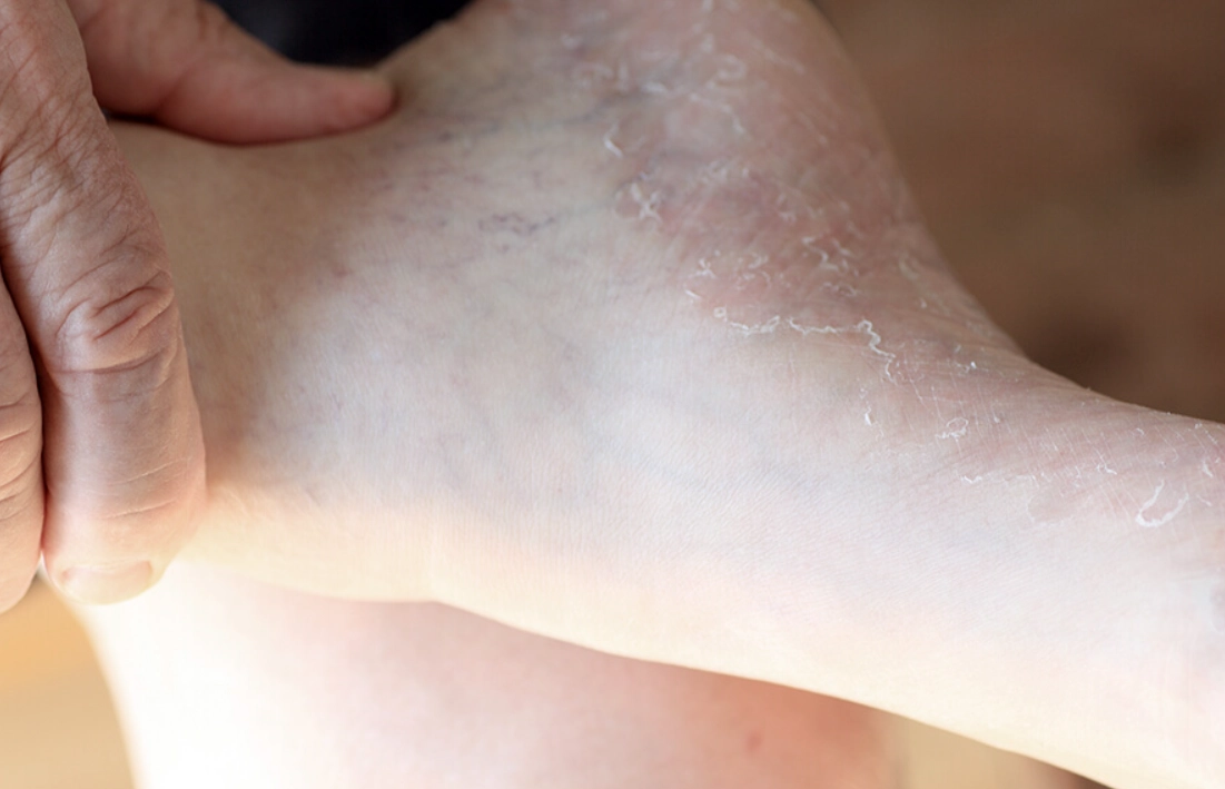 腳底脫皮維生素