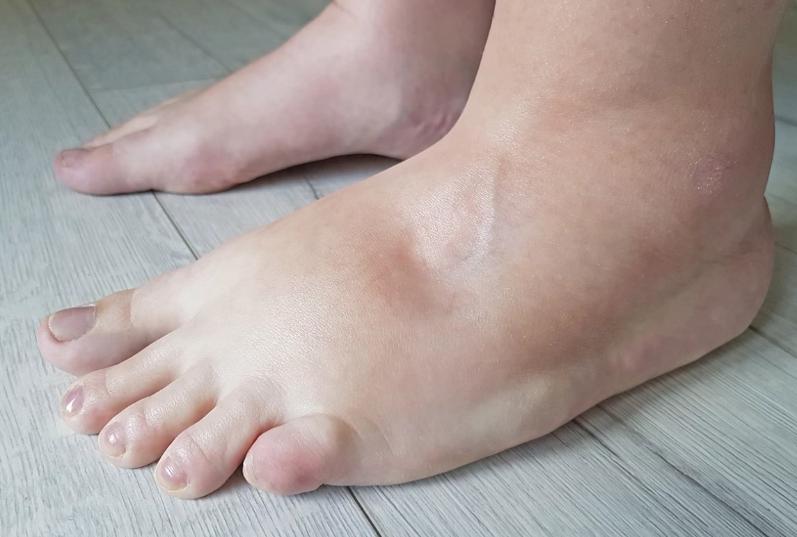 下肢水腫的原因及處置