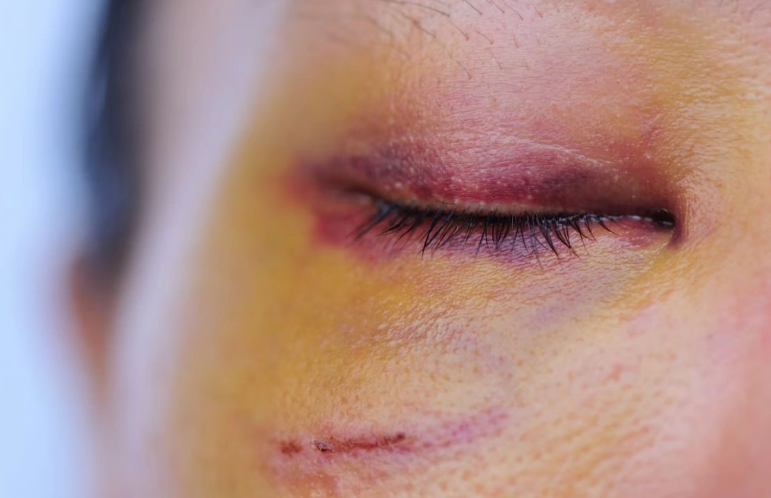 臉上瘀青怎麼消